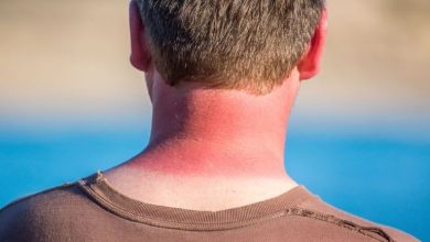 بهترین درمان آفتاب سوختگی و روش‌های جلوگیری از آن
