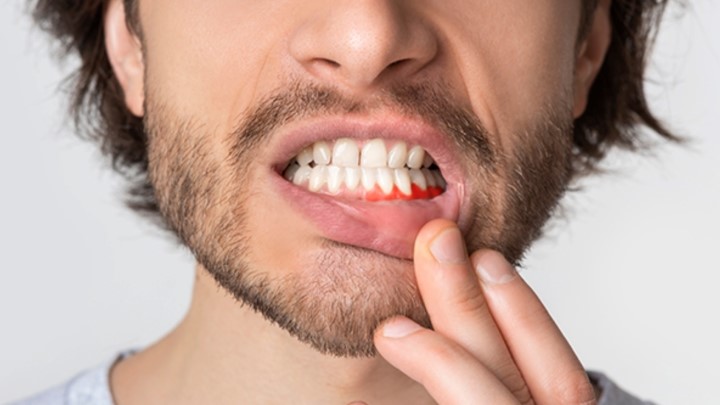 چگونه خونریزی لثه بعد از مسواک زدن را متوقف کنیم؟ چگونه خونریزی لثه بعد از مسواک زدن را متوقف کنیم؟