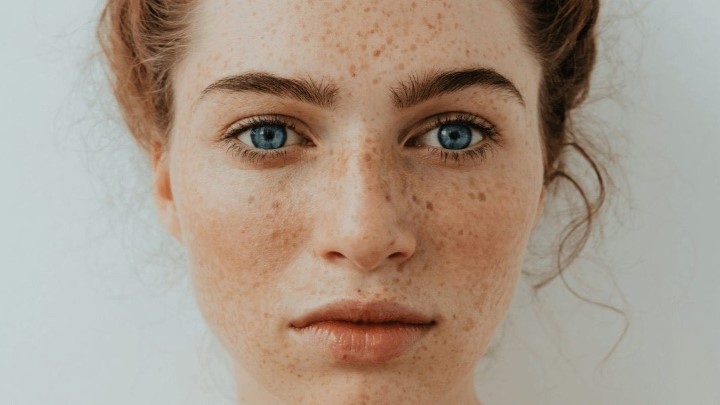 درمان خانگی کک و مک