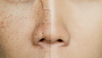 کک و مک را با این درمان‌های خانگی محو کنید