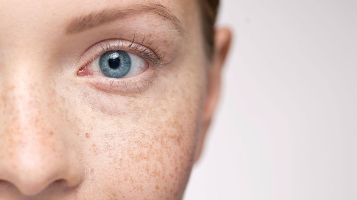 دلیل شکل‌گیری کک و مک