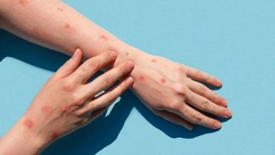 آبله میمون چیست؟ علائم و درمان