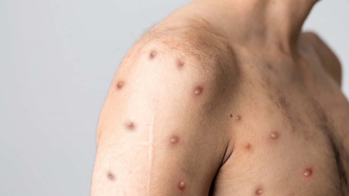 راههای درمان آبله میمون راههای درمان آبله میمون