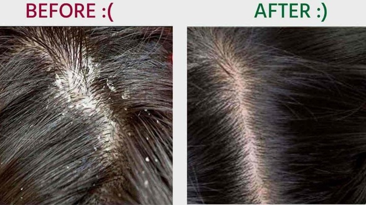 روشهای از بین بردن خارش و شوره سر با سرکه سیب روشهای از بین بردن خارش و شوره سر با سرکه سیب