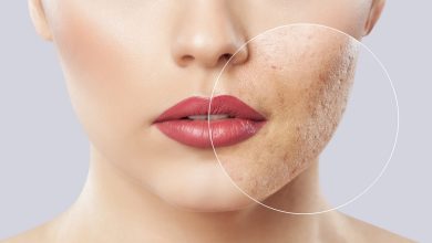 بهترین ترفندهای آرایشی برای پوشاندن فرورفتگی جای جوش